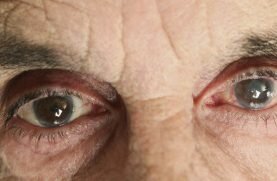 cataracta